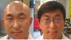 供应郑州脱发治疗|郑州脱发治疗哪家最专业【富发科技】