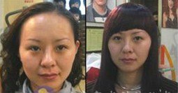 供应脂溢性脱发怎么办|治疗脂溢性脱发哪里好【富发科技】