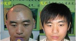 供应郑州脱发治疗中心|郑州脱发治疗哪里最好【富发科技】