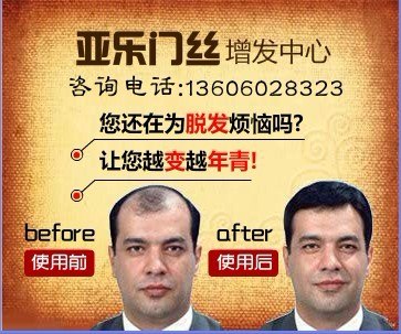 台湾专业技术 厦门织发 厦门育发 厦门生发