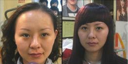 供应郑州脂溢性脱发怎么办|郑州脂溢性脱发治疗【富发科技】