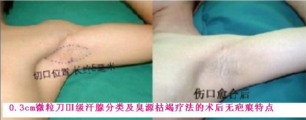 巩义哪医院治狐臭最好|洛阳交通医院微粒刀10分钟治愈狐臭