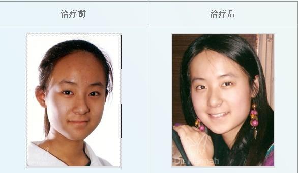 丘疹型痤疮应该怎么治疗？痤疮留下疤痕怎么办？痤疮的症状有哪些