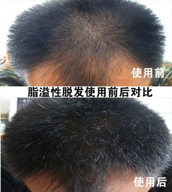 病理性脱发分哪几种情况！晶琳融娜