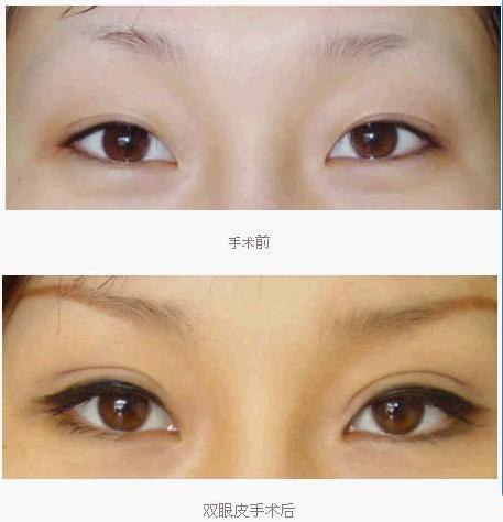 微创双眼皮手术--让眼睛焕发美丽采神