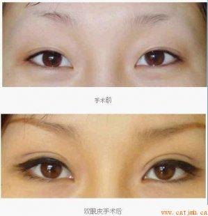 韩式双眼皮手术效果好不好？西安惠医生整形