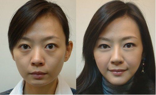 为什么西安惠医生韩式隆鼻术如此受追捧　