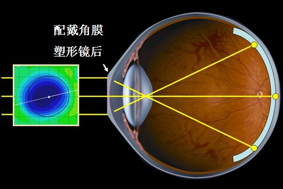 东营近视矫正 青少年近视了怎么办 欧几里德角膜塑