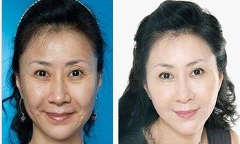 西安西京中医整形美容医院水光针多少钱？怎么样？