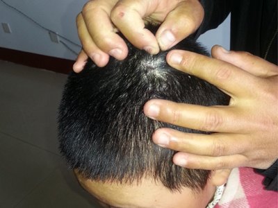 中药根治银屑病：物超所值的康俐肤原膏推荐