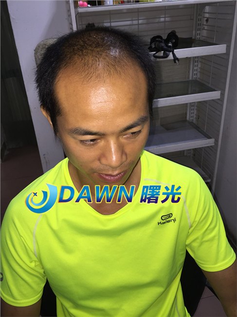 来看看我老公做的织发补发。